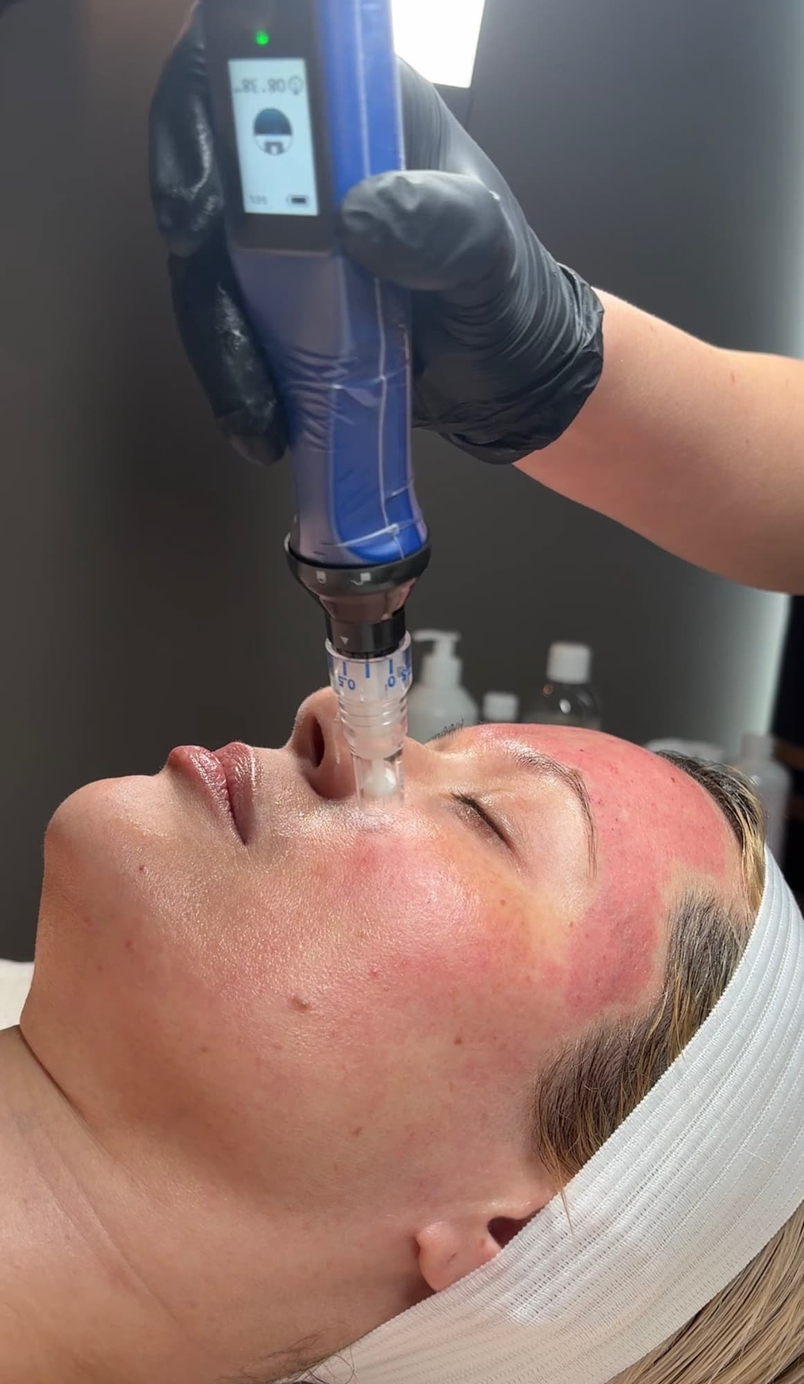 SkinPen microneedling skin resurfacing treatment at Luxe Forté Med Spa, Cherry Creek Denver